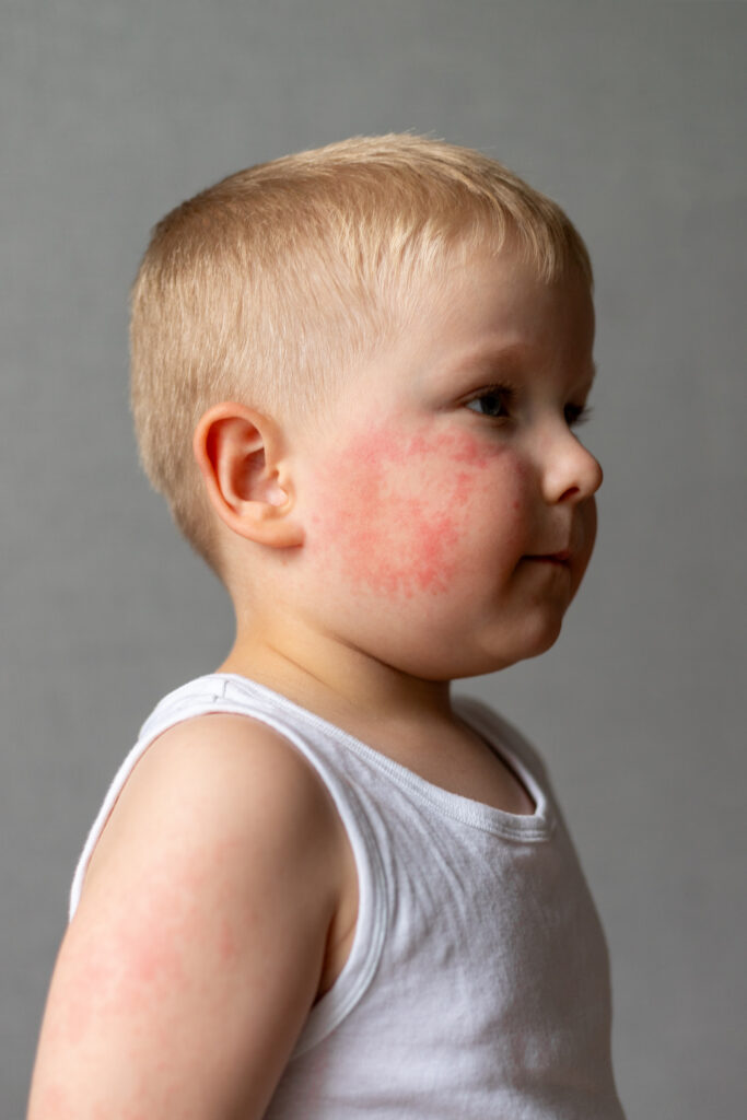 Eczema After Bath Time flare-up reduced with The Gulf Shower gentle bathing solution for children.