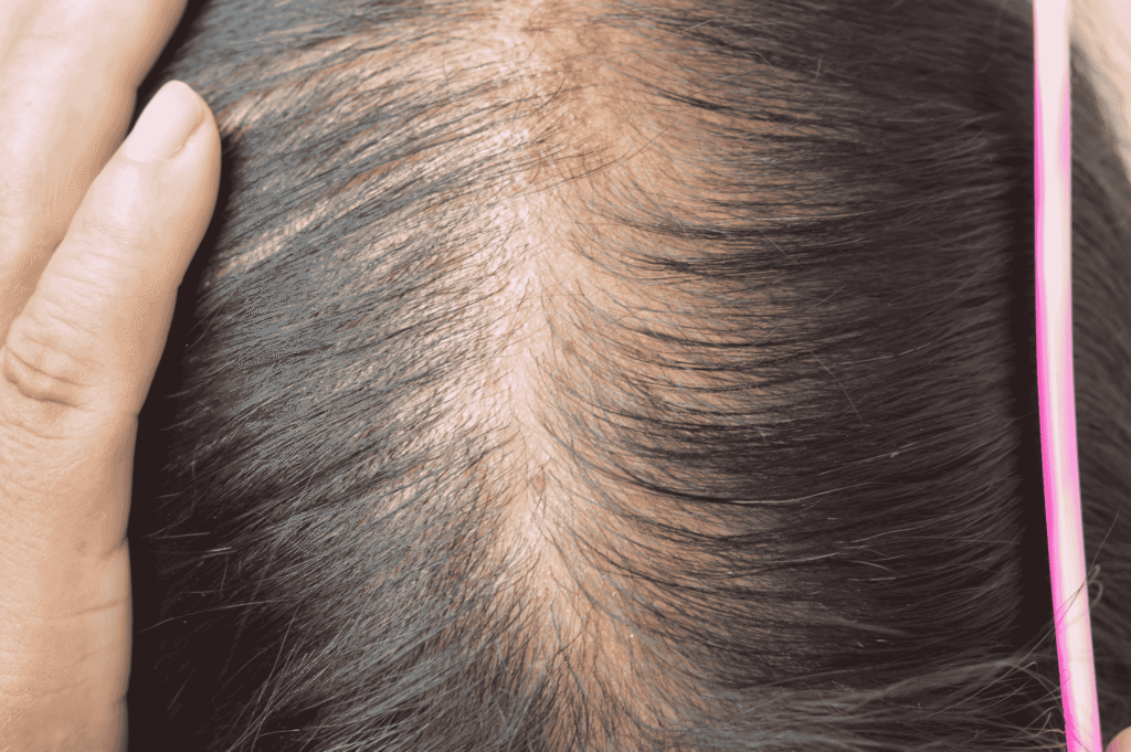 Hair thinning in your 30s—close-up of scalp showing reduced hair density, a common concern in dry or hard water climates.