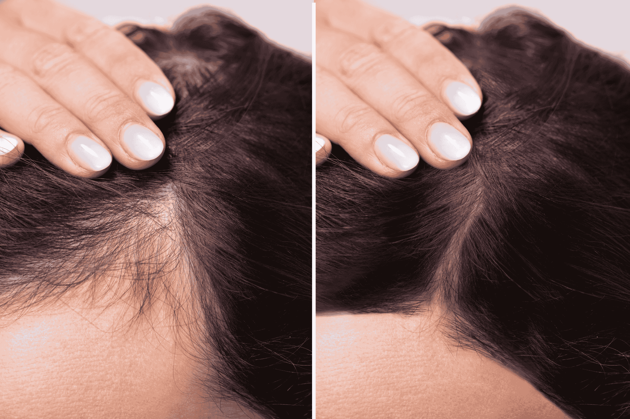 Hair thinning in your 30s is often misunderstood. This visual highlights the importance of protecting scalp health in hard water environments.