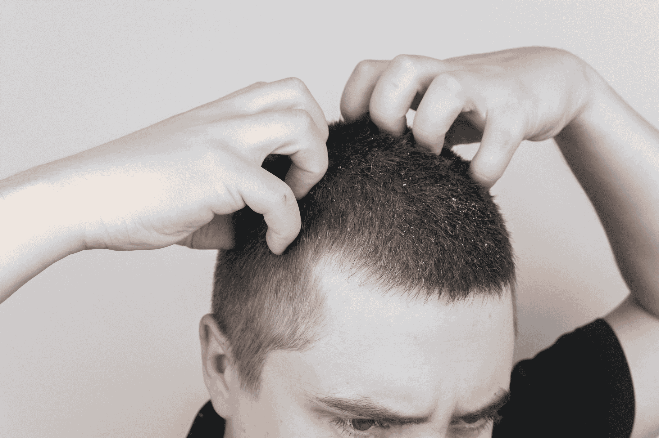 Itchy scalp after workouts—man scratching short hair with visible flakes, common in active men in hot climates.