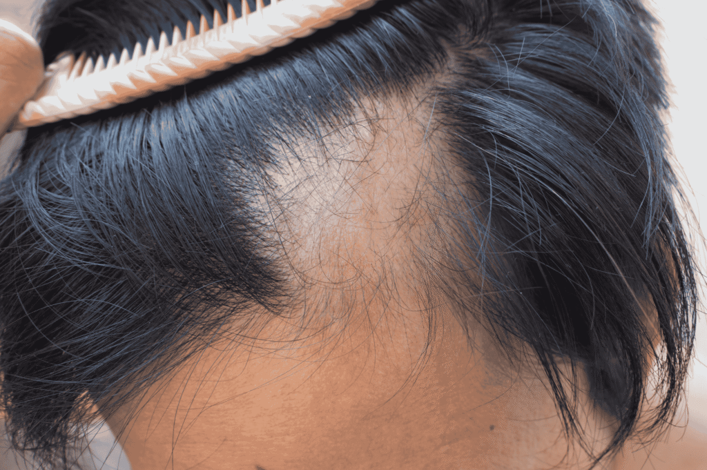 Hair thinning close-up caused by hard water exposure after moving to Dubai